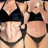 Vorher-nachher-Ergebnisse Mommy Makeover bei Memorial Göztepe Hospital, Bauchkontur verbessert
