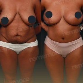 نتائج قبل وبعد عملية تجميل الأم في مستشفى Memorial Bahçelievler، نحت الجسم