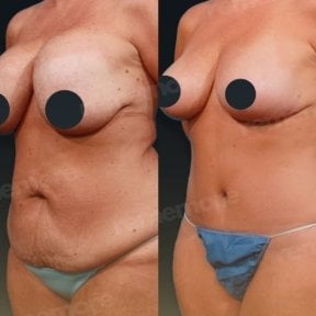 نتائج قبل وبعد عملية تجميل الأم في مستشفى ميموريال بهجيليفلر، نحت الجسم