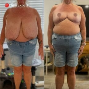 Resultados antes y después de reducción de senos en CE International Hospital, mejor contorno