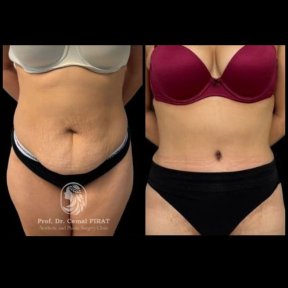 Vorher-nachher-Liposuktionsergebnis im Medical Park Antalya Hospital Complex, flacher Bauch