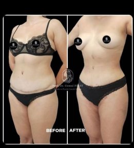 Vorher-nachher-Ergebnisse der Fettabsaugung im Medical Park Antalya Hospital Complex, Körperformung