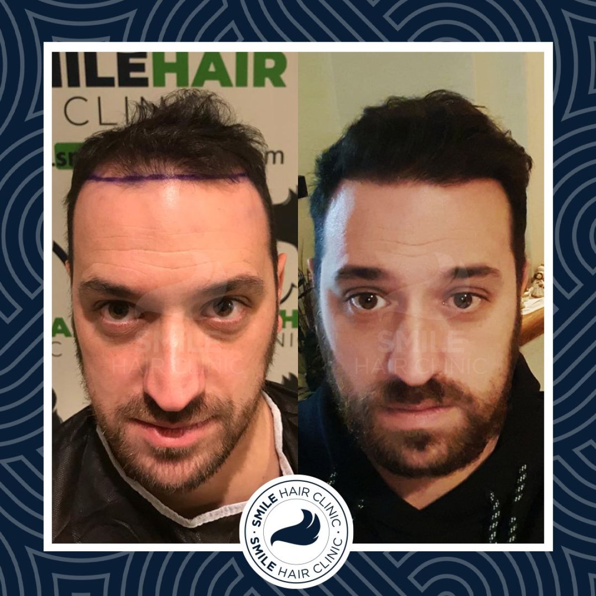 نتائج زراعة الشعر DHI قبل وبعد في Smile Hair Clinic، خط شعر محسّن لدى مريض ذكر