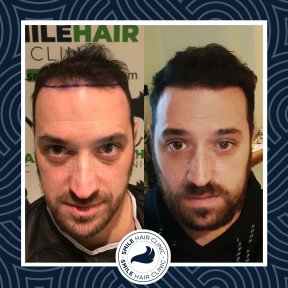 Результаты до и после DHI пересадки волос в Smile Hair Clinic, улучшенная линия волос у мужчины