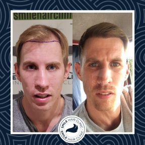 Результаты до и после пересадки волос DHI в Smile Hair Clinic — густая линия роста волос