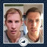 Результаты до и после пересадки волос DHI в Smile Hair Clinic — густая линия роста волос