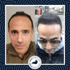 Результаты до и после DHI пересадки волос в Smile Hair Clinic – восстановленная линия роста волос