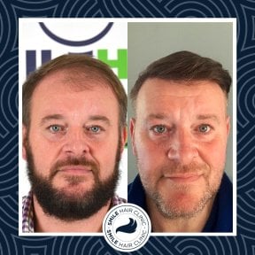 Результат до и после пересадки волос DHI в Smile Hair Clinic, улучшенная густота волос