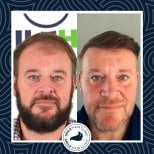 Результат до и после пересадки волос DHI в Smile Hair Clinic, улучшенная густота волос