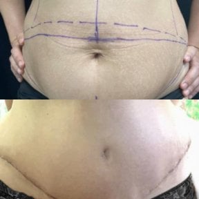 Результаты липосакции до и после в Yanhee International Hospital, улучшенный контур живота