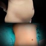 Результаты липосакции до и после в Yanhee International Hospital, улучшен контур живота