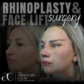 Resultados antes y después de lifting facial y rinoplastia en Soraca Med Istanbul, rejuvenecimiento