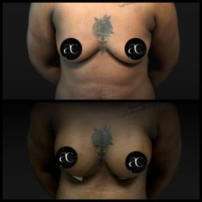 Resultados antes y después de aumento de senos en Soraca Med Istanbul, forma mejorada