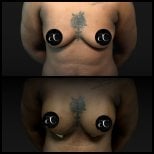 Resultados antes y después de aumento de senos en Soraca Med Istanbul, forma mejorada