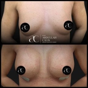 Resultados de aumento de senos antes y después en Soraca Med Istanbul, mayor volumen mamario