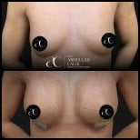 Resultados de aumento de senos antes y después en Soraca Med Istanbul, mayor volumen mamario