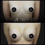 Resultados de aumento de senos antes y después en Soraca Med Istanbul, contorno más lleno