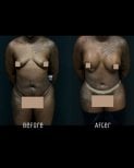 Resultados de abdominoplastia y contorno corporal antes y después en Soraca Med Istanbul
