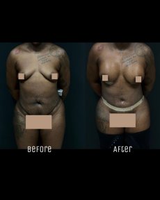 Vorher-nachher-Ergebnis Brazilian Butt Lift bei Soraca Med Istanbul, verbesserte Körperform
