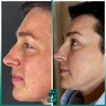 Vorher-nachher-Ergebnis Lidstraffung oben und unten bei Soraca Med Istanbul, verjüngter Blick