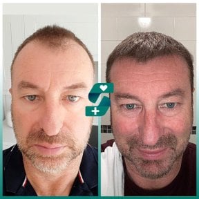 نتائج زراعة الشعر FUE قبل وبعد في Soraca Med Istanbul، كثافة شعر محسنة