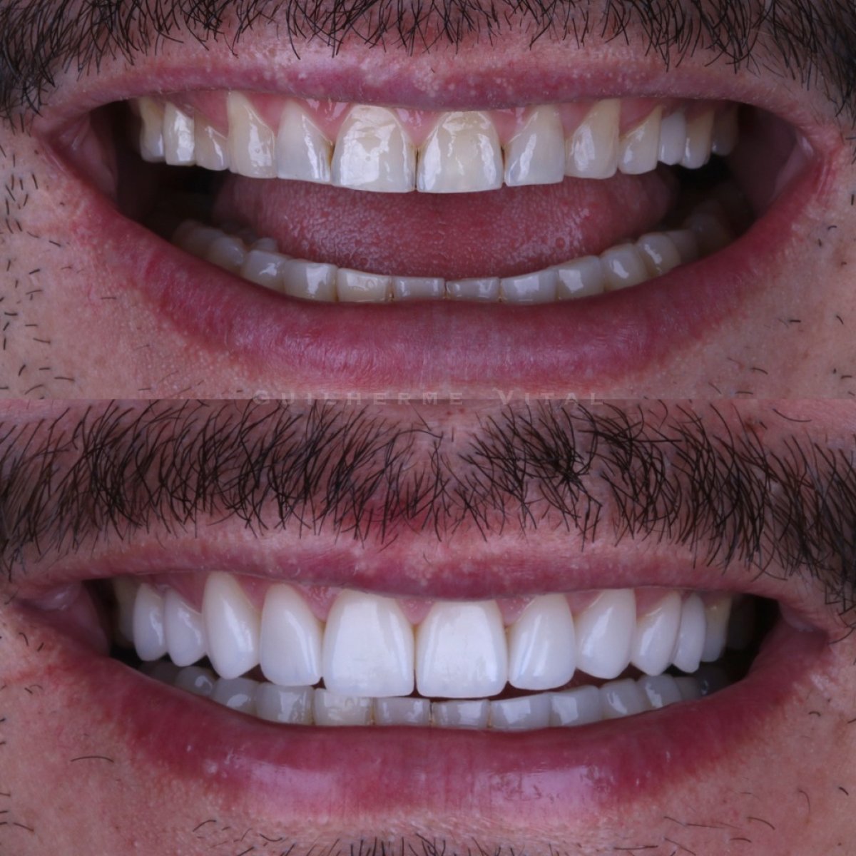 Resultados antes y después de carillas de porcelana – sonrisa mejorada y dientes más blancos