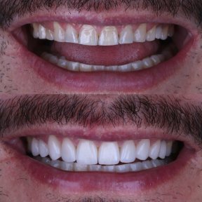 Vorher-nachher-Ergebnis Porzellanveneers – verbesserte Ästhetik und weißere Zähne
