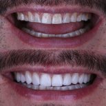Vorher-nachher-Ergebnis Porzellanveneers – verbesserte Ästhetik und weißere Zähne