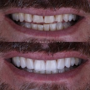 Vorher-nachher-Ergebnis Veneers – weißere, gerade Zähne nach Behandlung