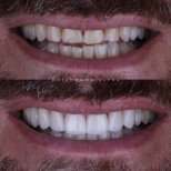 Vorher-nachher-Ergebnis Veneers – weißere, gerade Zähne nach Behandlung