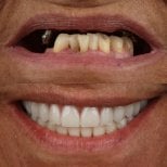 Resultados antes y después de implantes dentales All-on-4: restauración total de la sonrisa