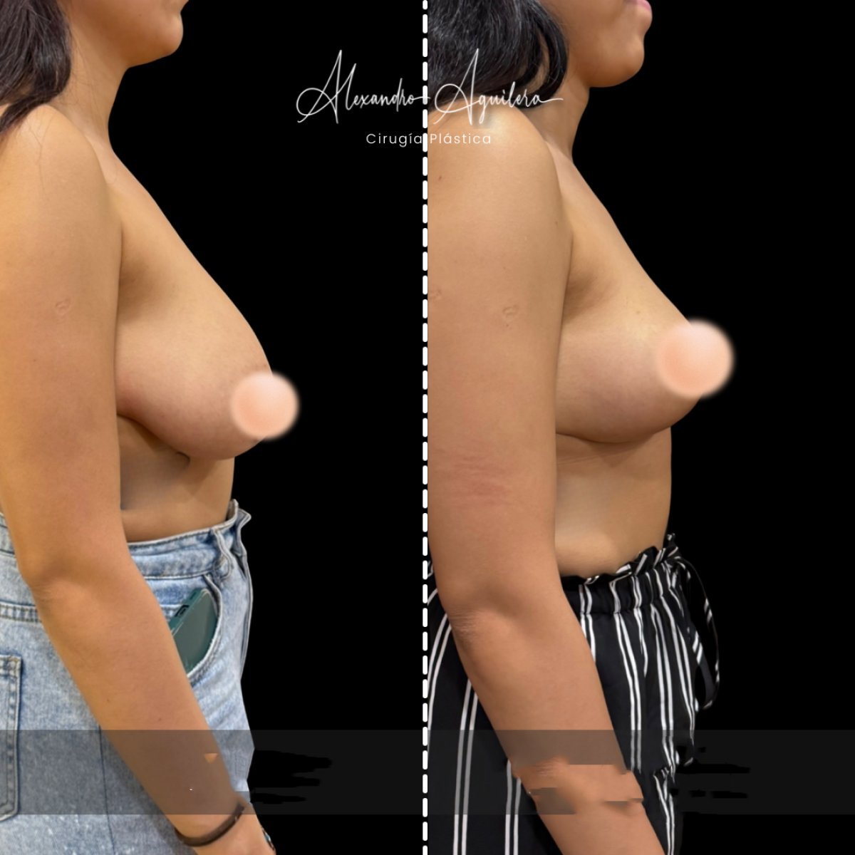 Before and after breast lift results at Alexandre Aguilera clinic – improved breast contour