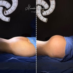 Before and after butt implants result at Alexandre Aguilera clinic – enhanced gluteal contour