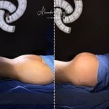 Before and after butt implants result at Alexandre Aguilera clinic – enhanced gluteal contour