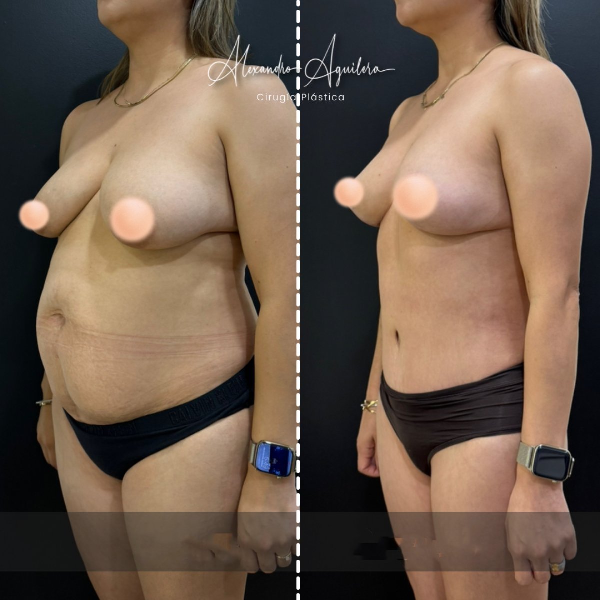 Resultados antes y después de mommy makeover en clínica Alexandre Aguilera – mejora corporal