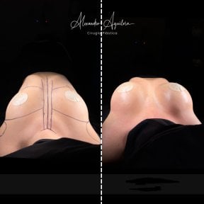 Vorher-nachher-Ergebnisse Brustvergrößerung bei Alexandre Aguilera Cirugía Plástica