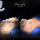 Результаты до и после mommy makeover в клинике Alexandre Aguilera – видимый контур тела