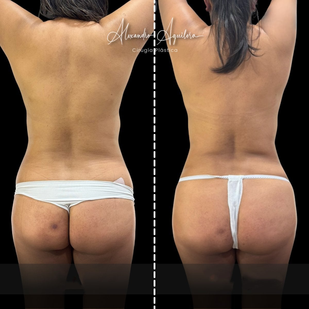 نتائج قبل وبعد عملية تجميل الأم في Alexandre Aguilera – تحسين شكل الجسم