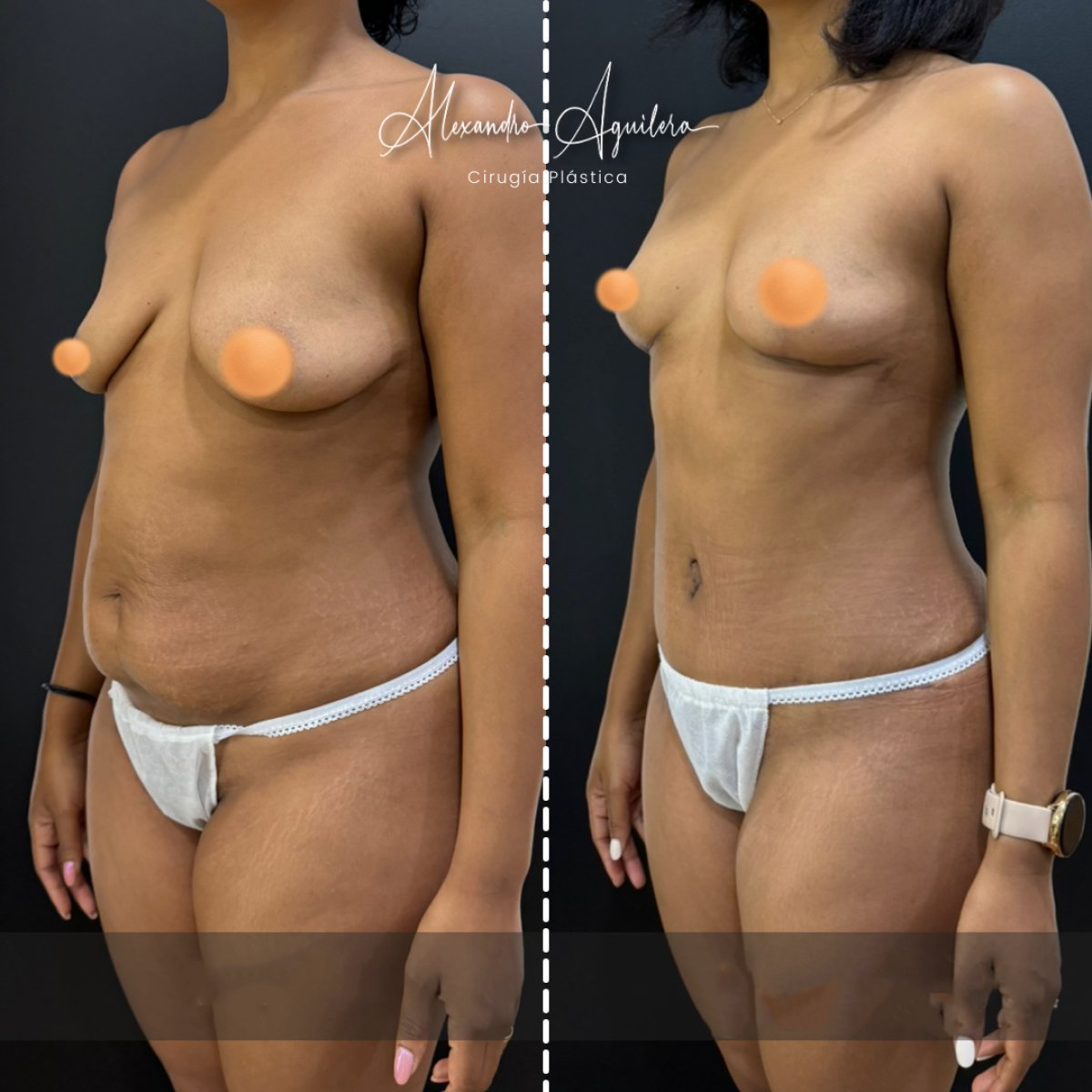 Resultados antes y después de mommy makeover en clínica Alexandre Aguilera – mejor contorno corporal