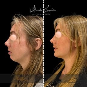 Before and after chin augmentation results at Alexandre Aguilera clinic, improved chin profile