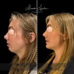 Before and after chin augmentation results at Alexandre Aguilera clinic, improved chin profile