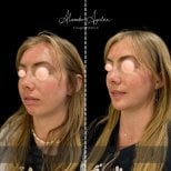 Before and after chin augmentation results at Alexandre Aguilera clinic, enhanced chin profile