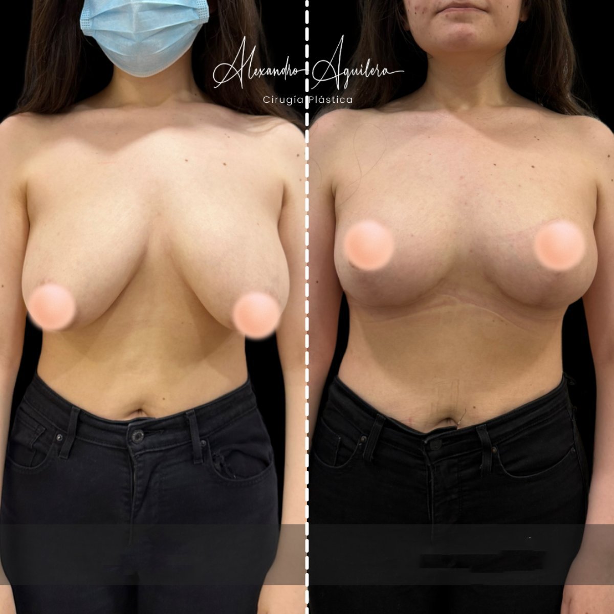Before and after breast lift results at Alexandre Aguilera clinic, improved breast contour