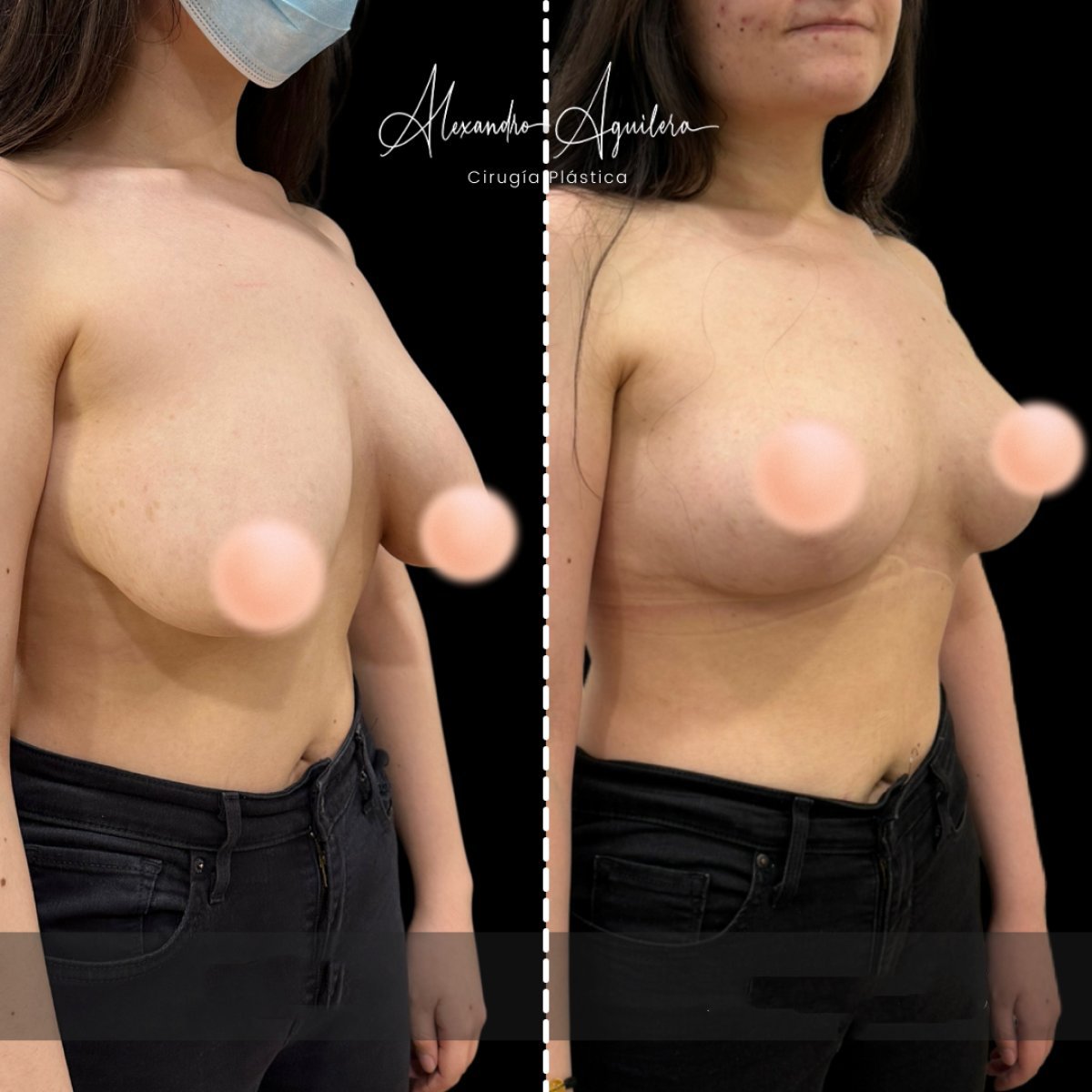 Before and after breast lift results at Alexandre Aguilera clinic, improved breast contour