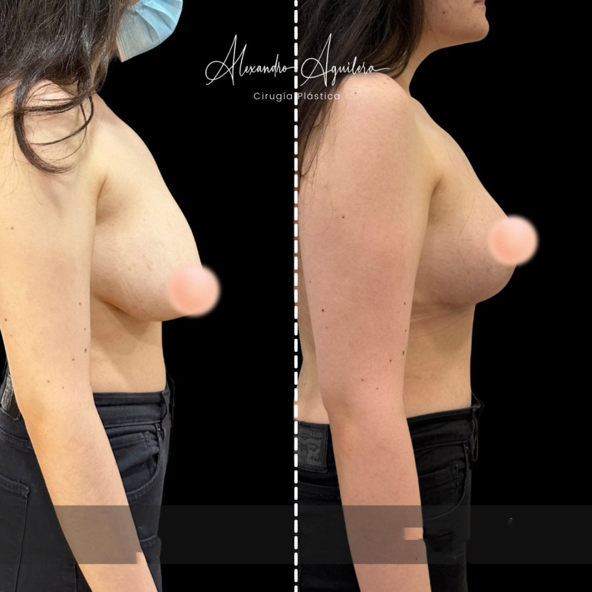 Resultados de mastopexia antes y después en clínica Alexandre Aguilera, mejor contorno mamario