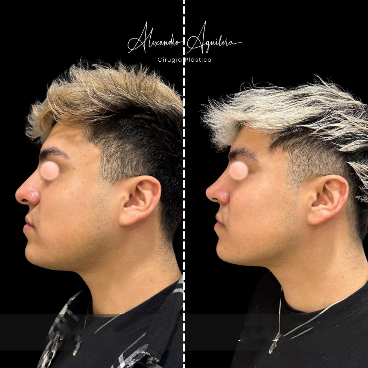 نتيجة تجميل الأنف للرجال قبل وبعد في Alexandre Aguilera، تحسين شكل الأنف