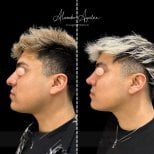 Результат ринопластики у мужчины до и после в Alexandre Aguilera, улучшен профиль носа