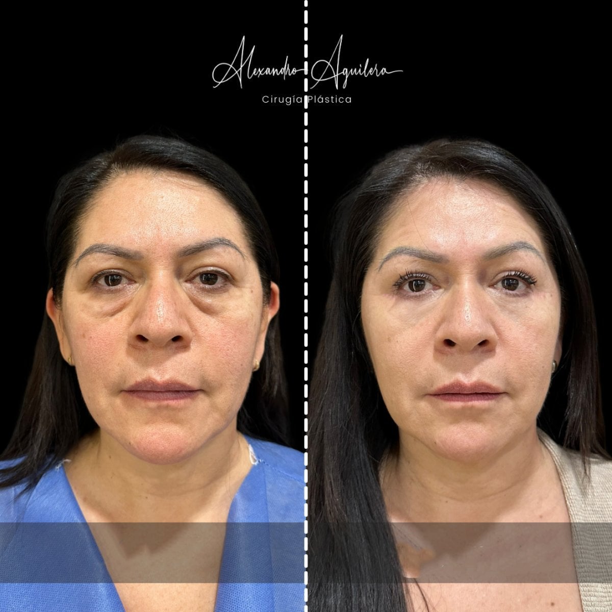 Before and after upper and lower eyelid surgery results at Alexandre Aguilera clinic