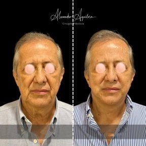Результаты до и после фейслифтинга в клинике Alexandre Aguilera, омоложение лица