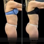 Before and after butt implants at Alexandre Aguilera clinic – enhanced gluteal contour result
